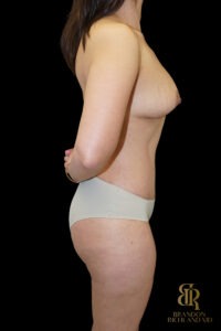 Tummy Tuck before and after, Case #14697 — Dr. Brandon Richland, Newport Beach