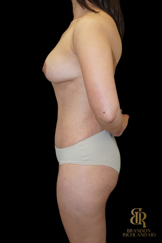 Tummy Tuck After, Case #14697, view 5 — Dr. Brandon Richland, Newport Beach