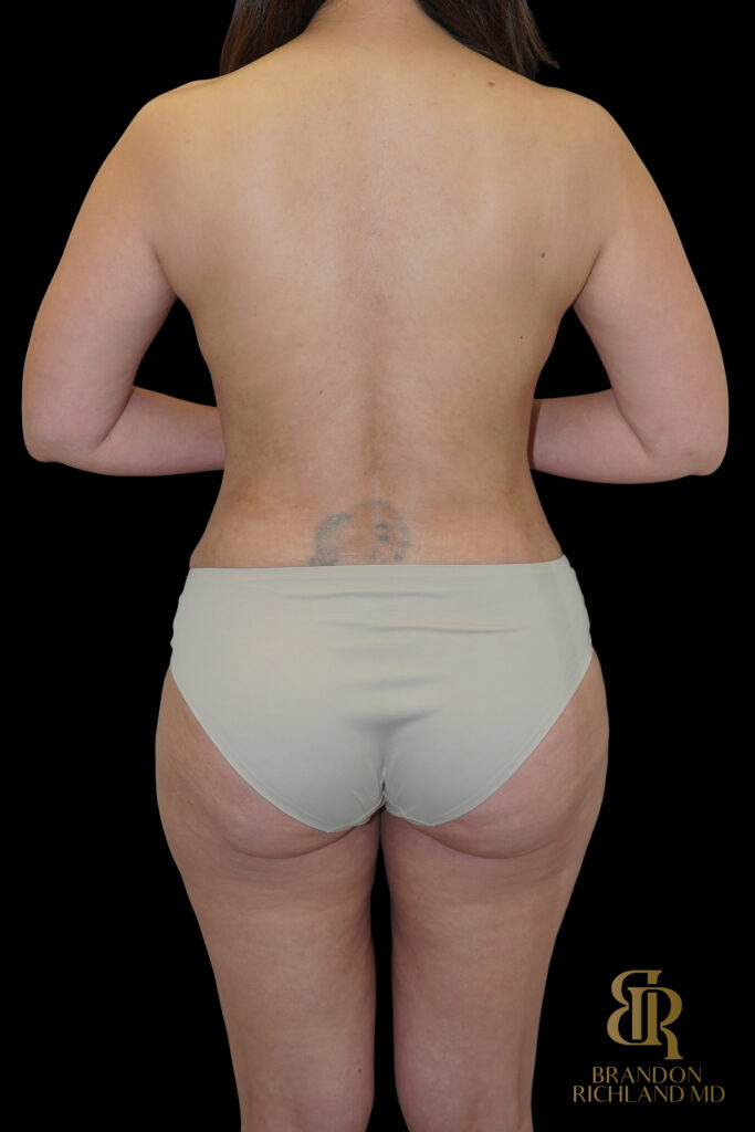 Tummy Tuck After, Case #14697, view 6 — Dr. Brandon Richland, Newport Beach