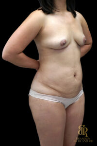 Tummy Tuck before and after, Case #14697 — Dr. Brandon Richland, Newport Beach