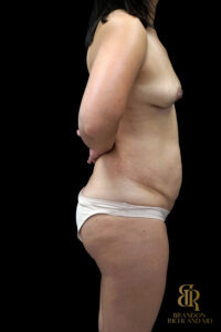 Tummy Tuck before and after, Case #14697 — Dr. Brandon Richland, Newport Beach