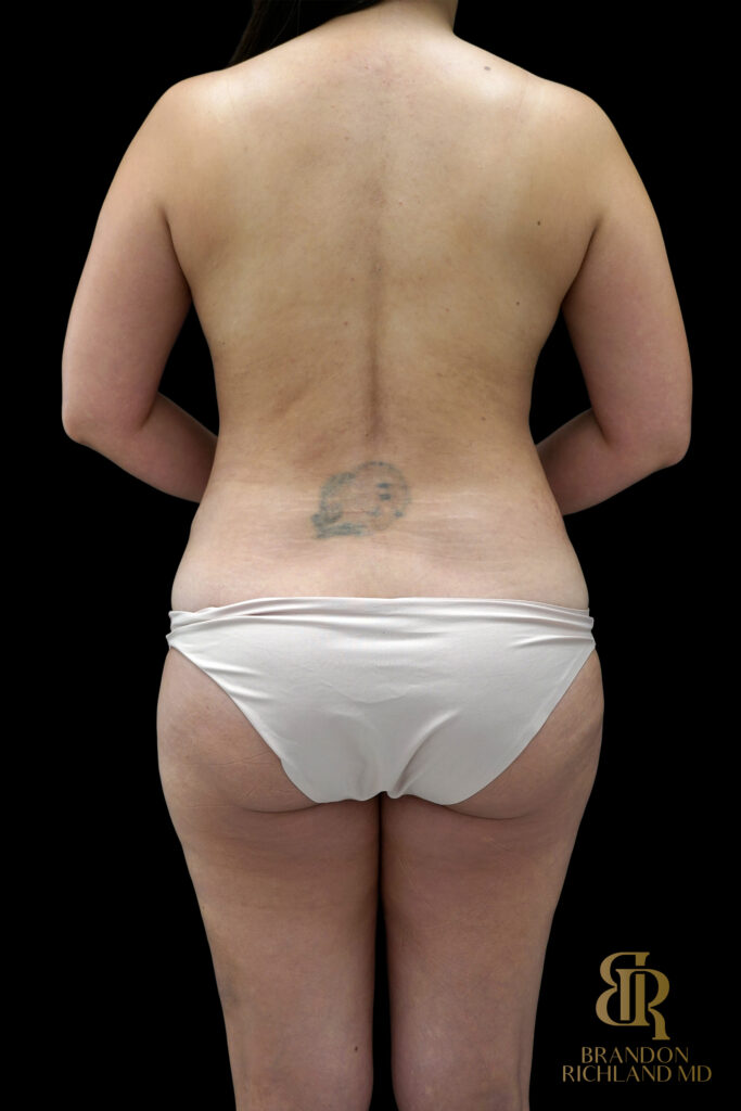 Tummy Tuck Before, Case #14697, view 6 — Dr. Brandon Richland, Newport Beach