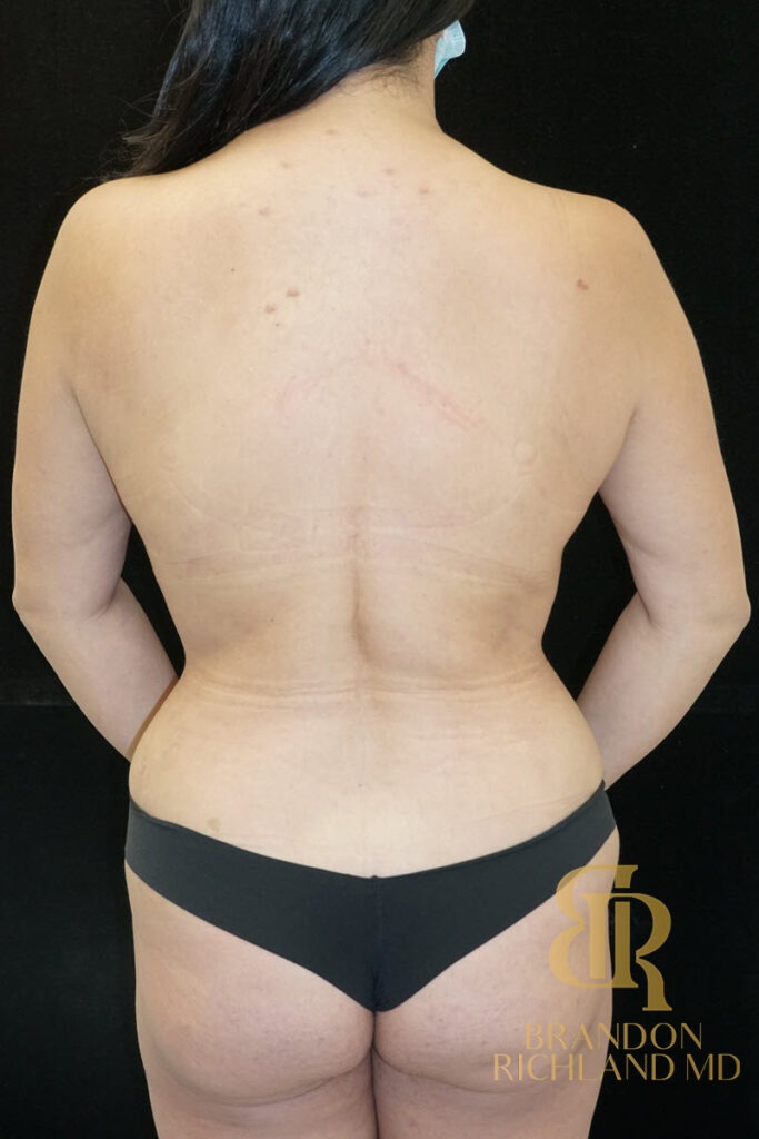 Mommy Makeover After, Patient 18, view 6 — Dr. Brandon Richland, Newport Beach