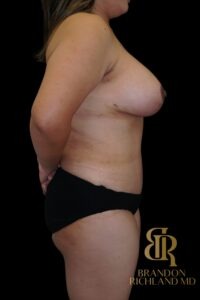 Mommy Makeover before and after, Patient 19 — Dr. Brandon Richland, Newport Beach