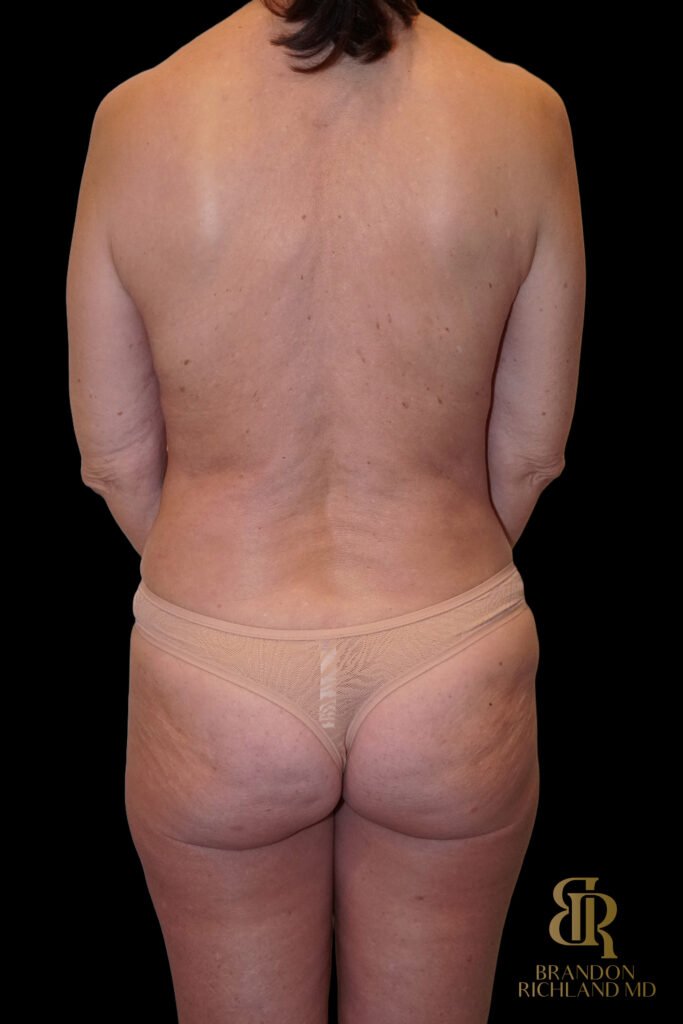 Tummy Tuck After, Case #40629, view 6 — Dr. Brandon Richland, Newport Beach