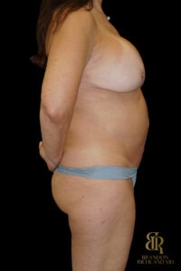 Tummy Tuck before and after, Case #40629 — Dr. Brandon Richland, Newport Beach