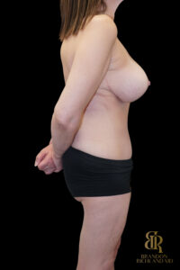 Tummy Tuck before and after, Case #85398 — Dr. Brandon Richland, Newport Beach