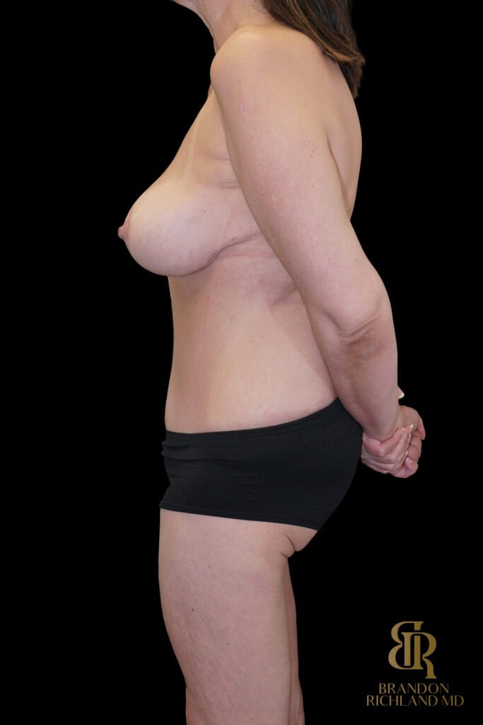 Tummy Tuck After, Case #85398, view 5 — Dr. Brandon Richland, Newport Beach