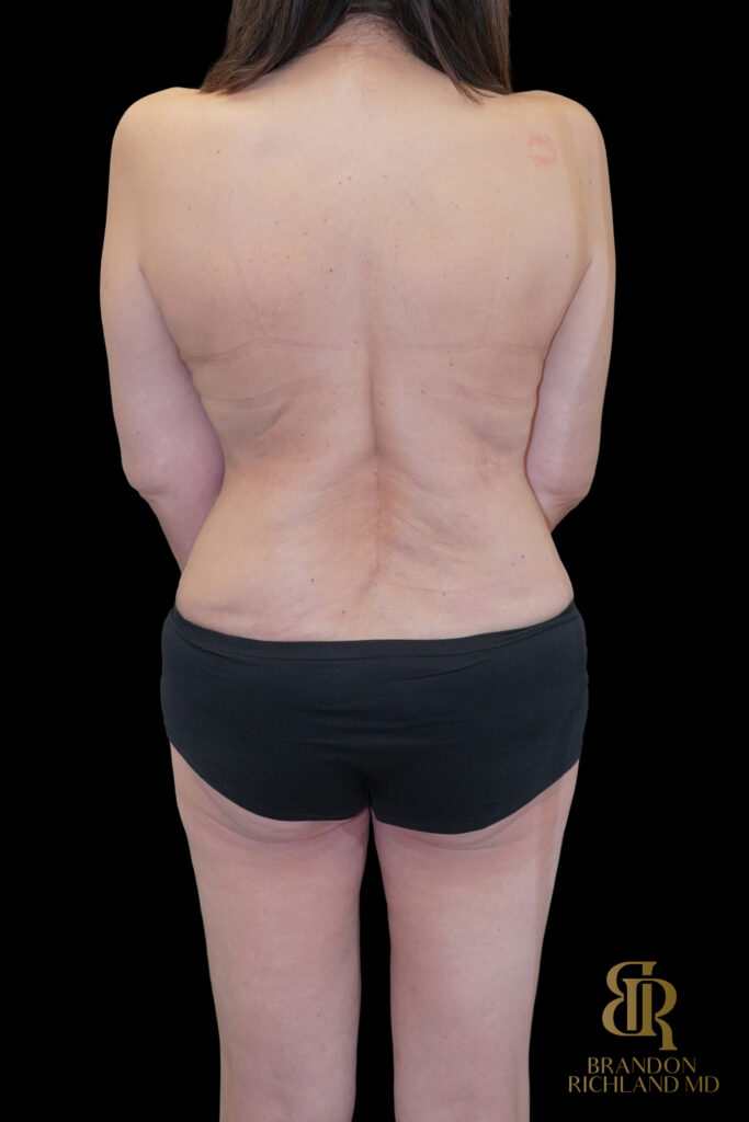Tummy Tuck After, Case #85398, view 6 — Dr. Brandon Richland, Newport Beach