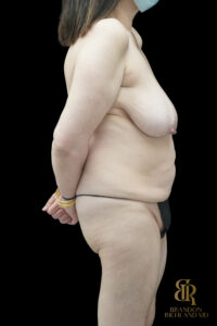 Tummy Tuck before and after, Case #85398 — Dr. Brandon Richland, Newport Beach