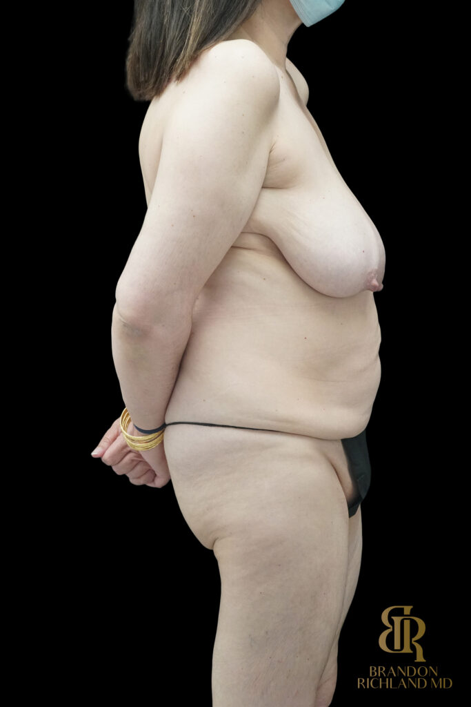 Tummy Tuck Before, Case #85398, view 3 — Dr. Brandon Richland, Newport Beach