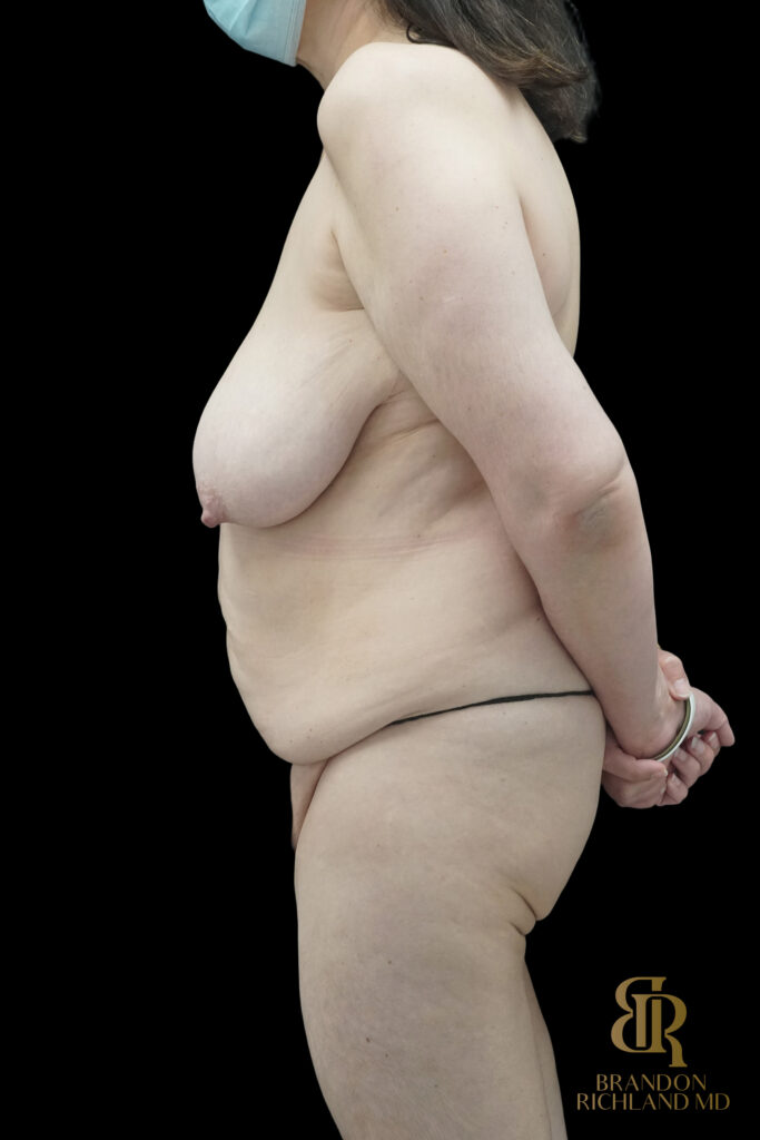 Tummy Tuck Before, Case #85398, view 5 — Dr. Brandon Richland, Newport Beach