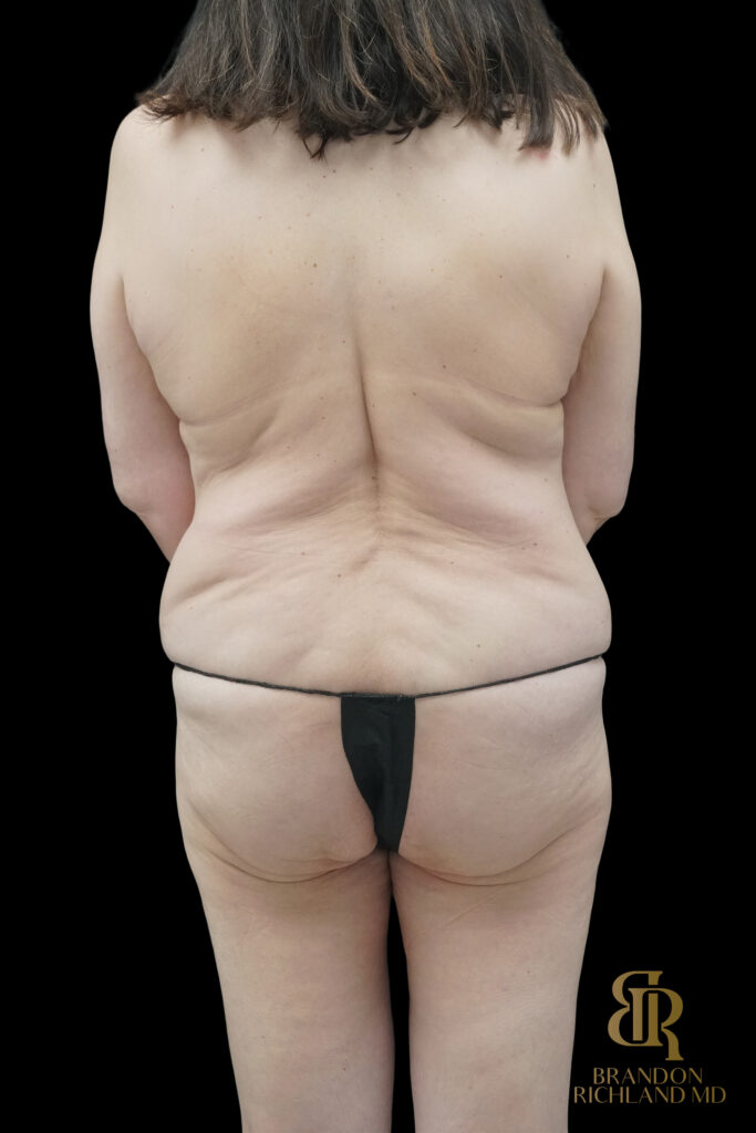 Tummy Tuck Before, Case #85398, view 6 — Dr. Brandon Richland, Newport Beach
