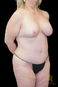 Tummy Tuck before and after, Case #96500 — Dr. Brandon Richland, Newport Beach