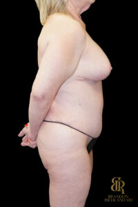 Tummy Tuck before and after, Case #96500 — Dr. Brandon Richland, Newport Beach