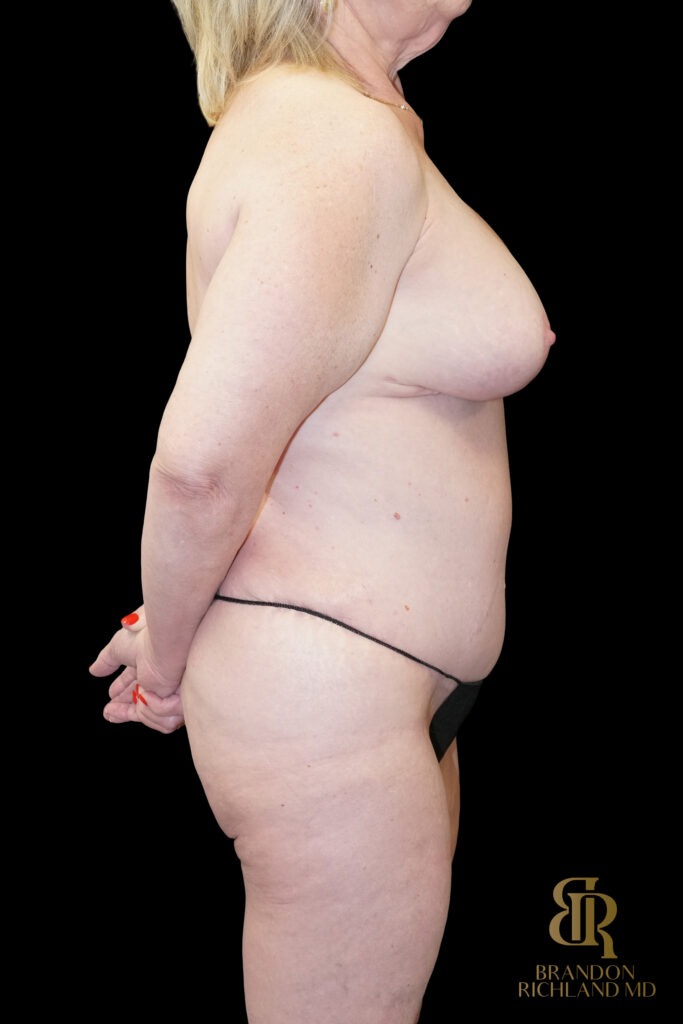 Tummy Tuck After, Case #96500, view 3 — Dr. Brandon Richland, Newport Beach