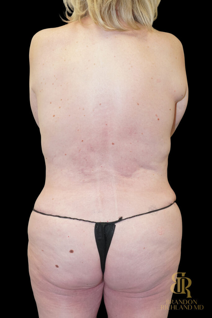 Tummy Tuck After, Case #96500, view 6 — Dr. Brandon Richland, Newport Beach