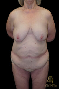 Tummy Tuck before and after, Case #96500 — Dr. Brandon Richland, Newport Beach