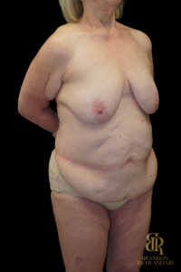 Tummy Tuck before and after, Case #96500 — Dr. Brandon Richland, Newport Beach