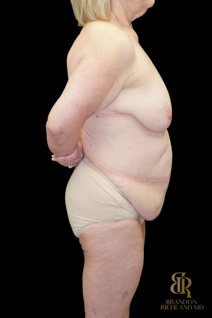 Tummy Tuck Before, Case #96500, view 3 — Dr. Brandon Richland, Newport Beach