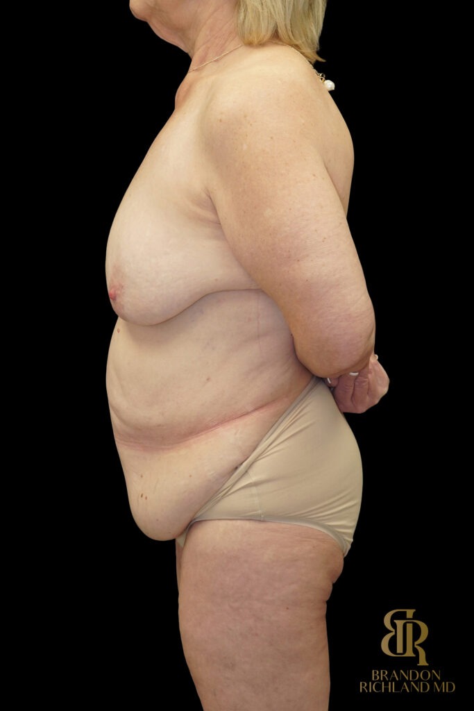 Tummy Tuck Before, Case #96500, view 5 — Dr. Brandon Richland, Newport Beach