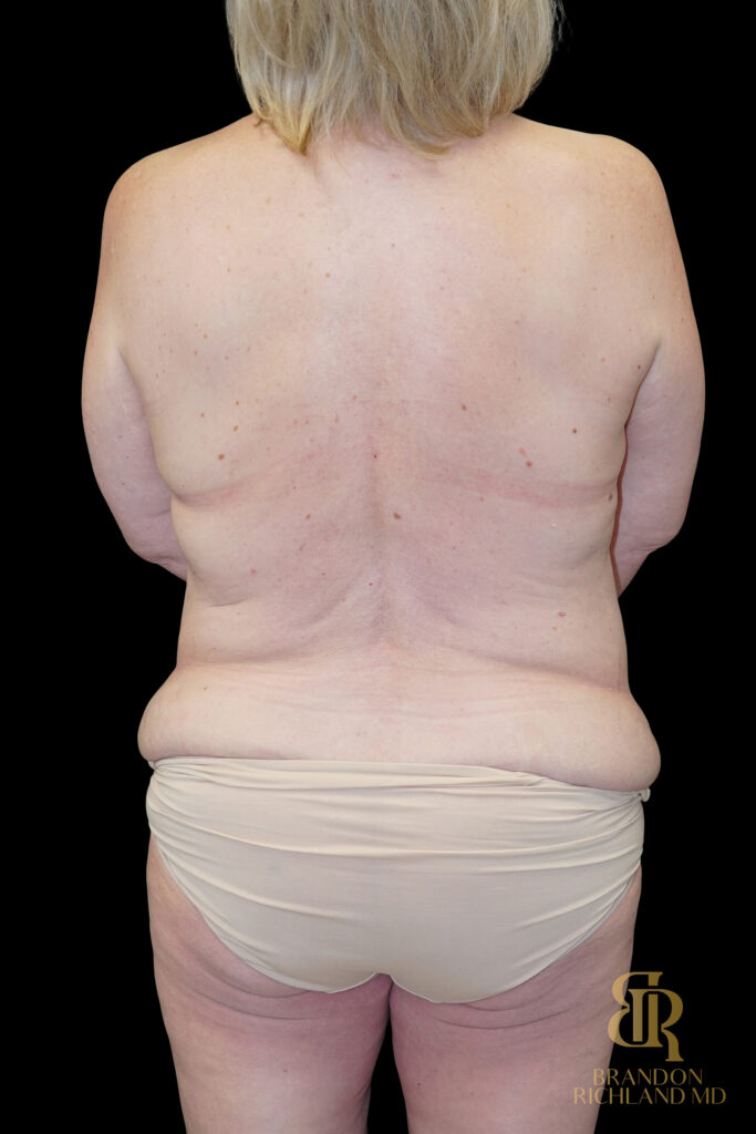 Tummy Tuck Before, Case #96500, view 6 — Dr. Brandon Richland, Newport Beach