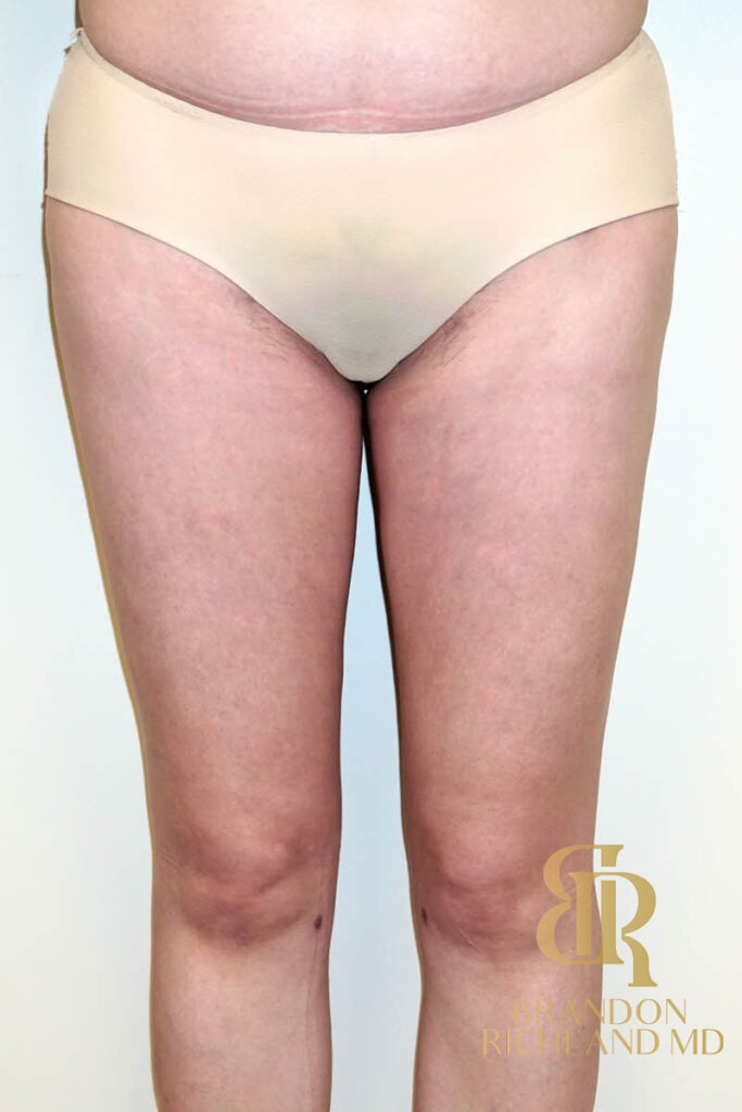 Renuvion Skin Tightening After, Patient 01, view 3 — Dr. Brandon Richland, Newport Beach