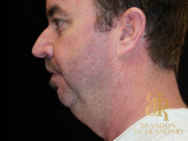 Renuvion Skin Tightening Before, Patient 05, view 2 — Dr. Brandon Richland, Newport Beach