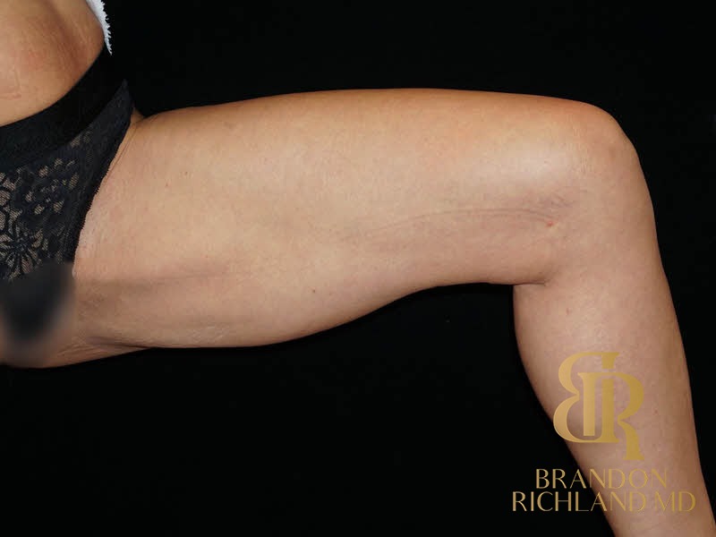 Renuvion Skin Tightening Before, Patient 06, view 2 — Dr. Brandon Richland, Newport Beach