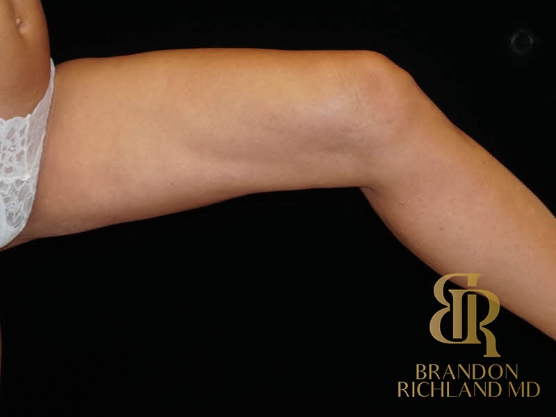 Renuvion Skin Tightening After, Patient 06, view 2 — Dr. Brandon Richland, Newport Beach