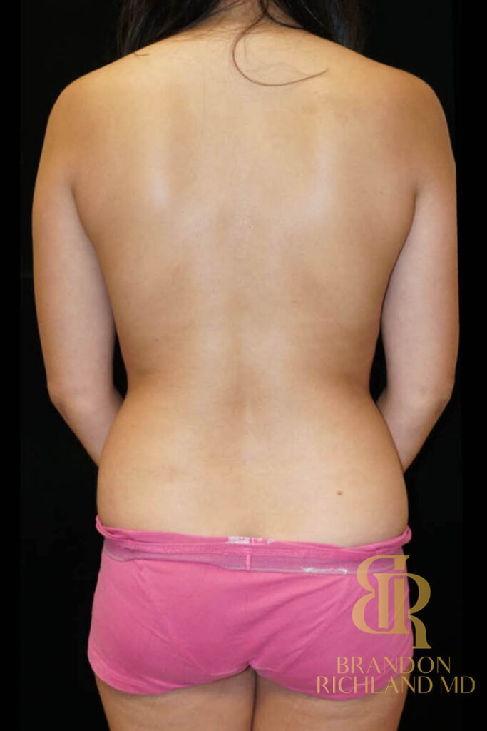 Renuvion Skin Tightening Before, Patient 08, view 6 — Dr. Brandon Richland, Newport Beach