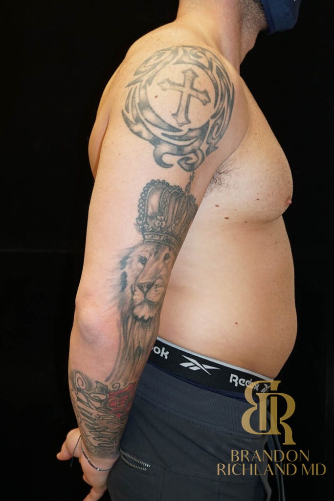 Renuvion Skin Tightening Before, Patient 12, view 3 — Dr. Brandon Richland, Newport Beach