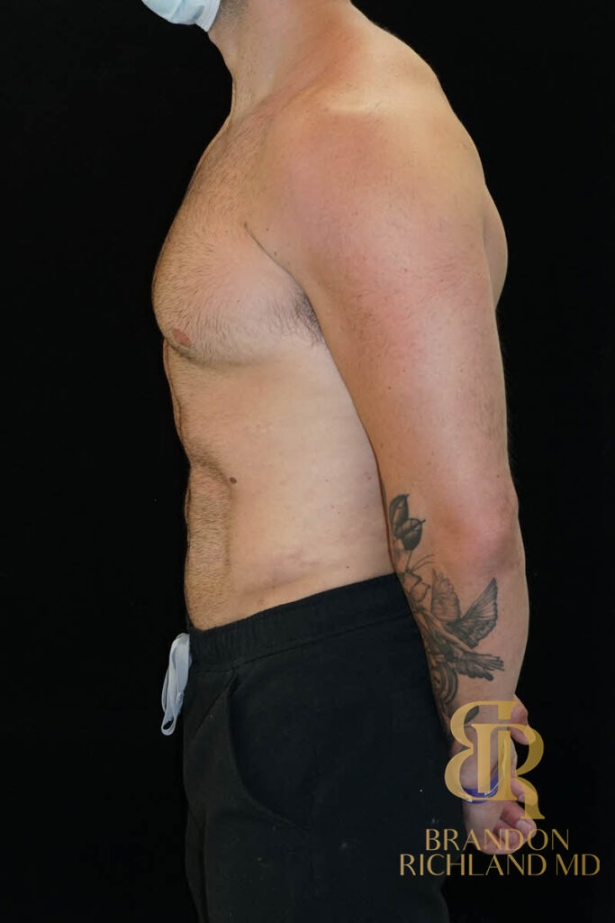 Renuvion Skin Tightening After, Patient 12, view 5 — Dr. Brandon Richland, Newport Beach