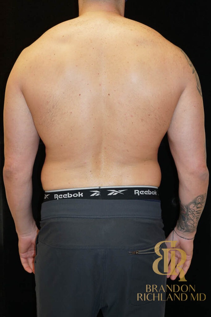 Renuvion Skin Tightening Before, Patient 12, view 6 — Dr. Brandon Richland, Newport Beach