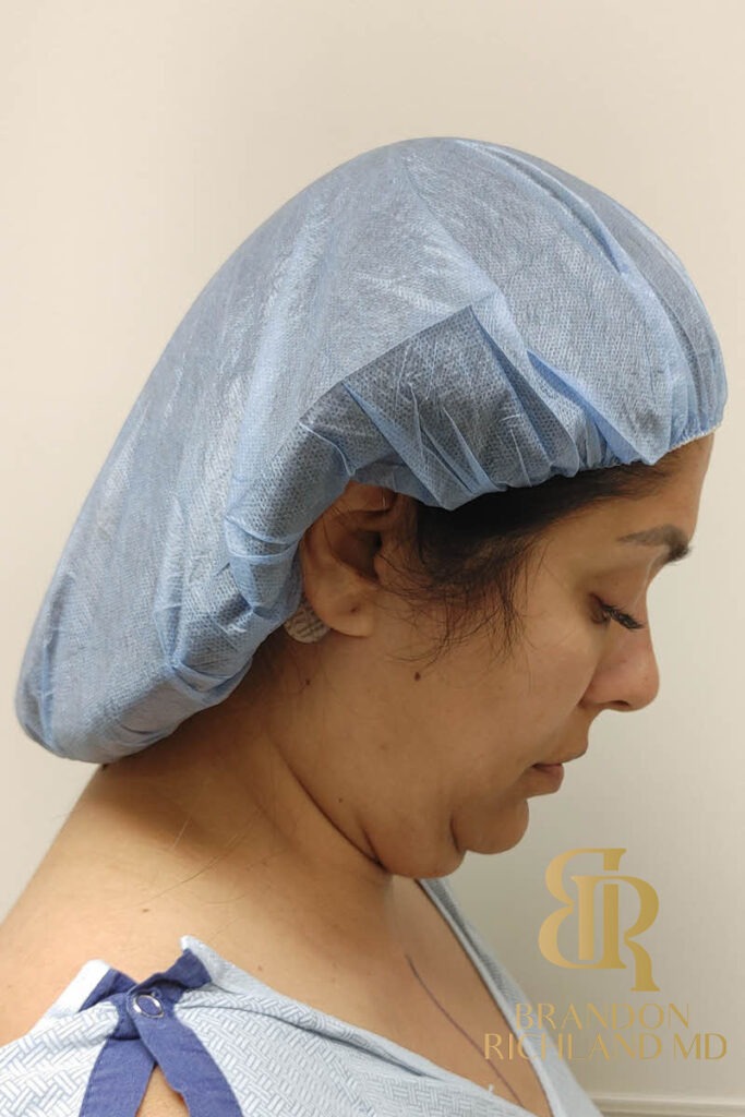Renuvion Skin Tightening Before, Patient 14, view 4 — Dr. Brandon Richland, Newport Beach