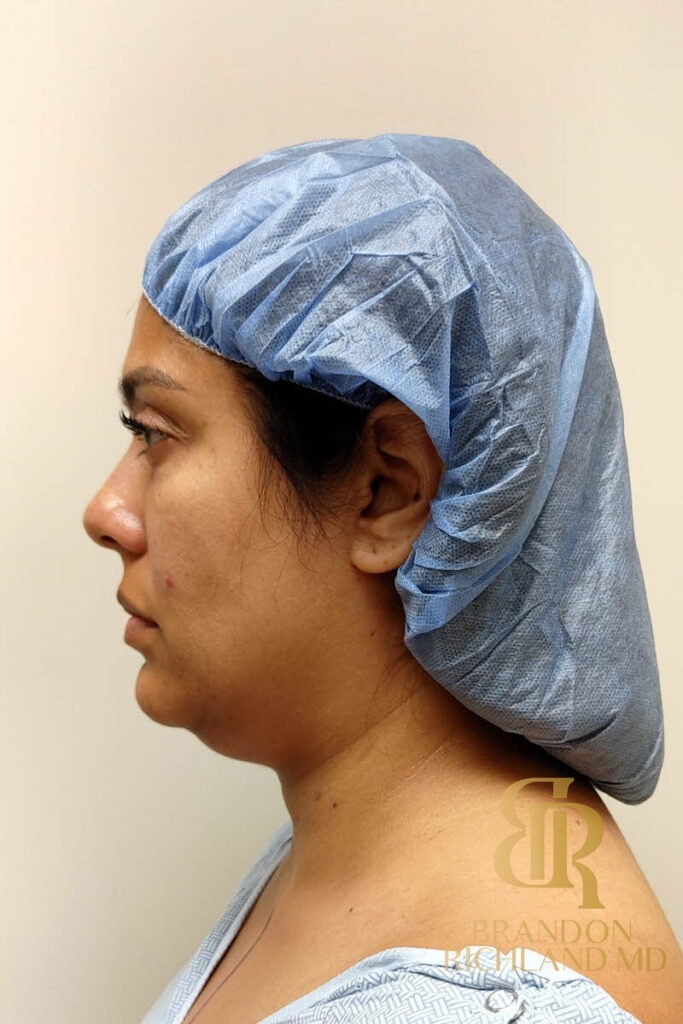 Renuvion Skin Tightening Before, Patient 14, view 6 — Dr. Brandon Richland, Newport Beach