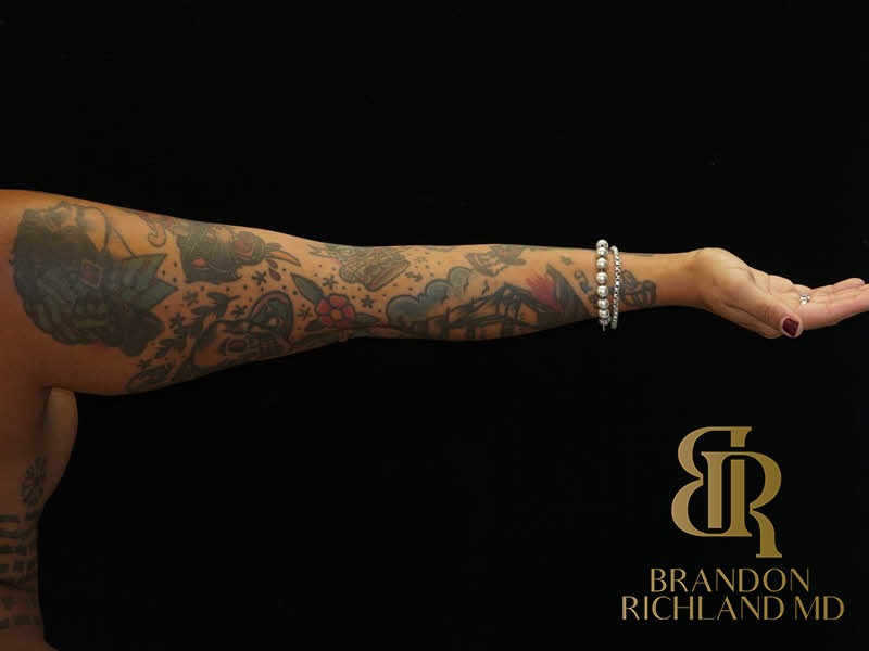 Renuvion Skin Tightening Before, Patient 24, view 10 — Dr. Brandon Richland, Newport Beach