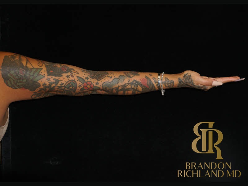 Renuvion Skin Tightening After, Patient 24, view 10 — Dr. Brandon Richland, Newport Beach