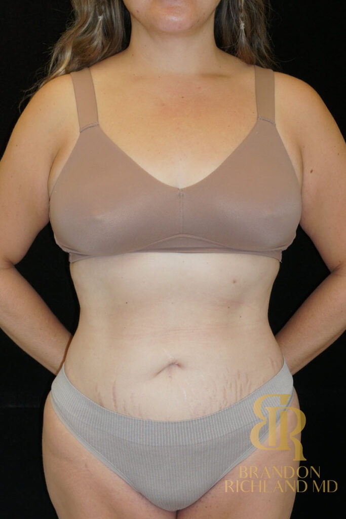 Renuvion Skin Tightening After, Patient 36, view 1 — Dr. Brandon Richland, Newport Beach