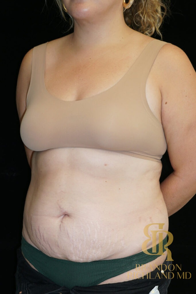 Renuvion Skin Tightening Before, Patient 36, view 4 — Dr. Brandon Richland, Newport Beach
