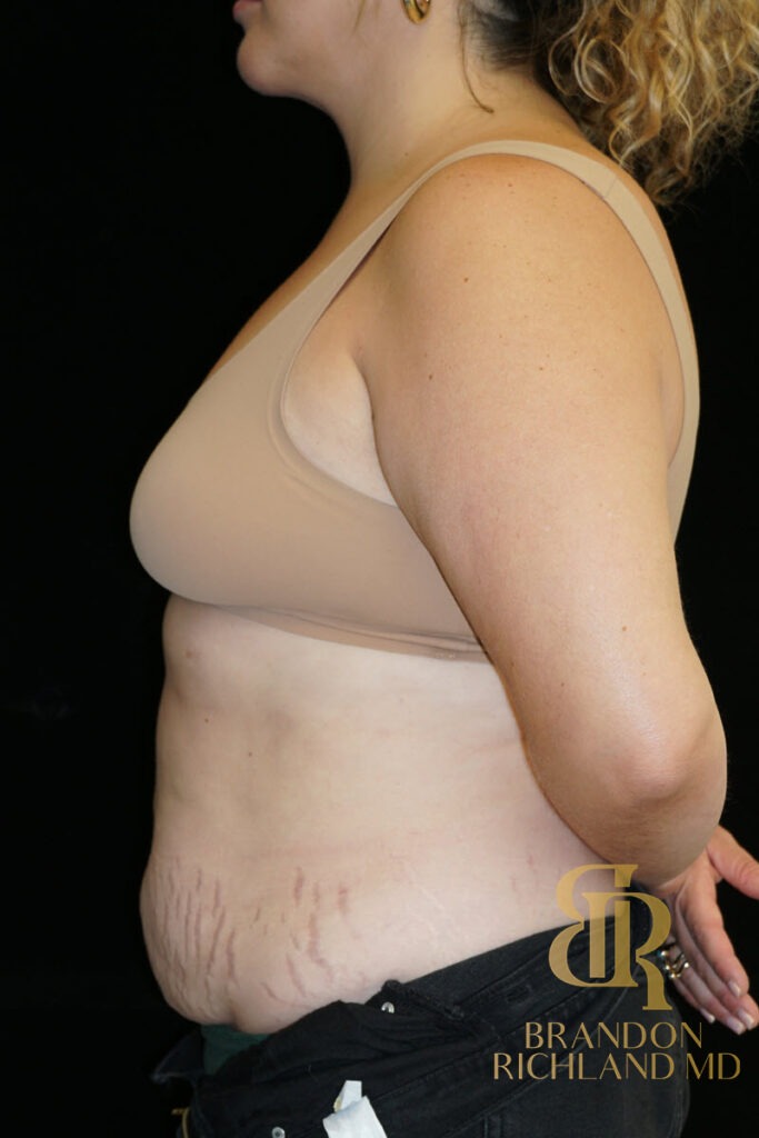Renuvion Skin Tightening Before, Patient 36, view 5 — Dr. Brandon Richland, Newport Beach