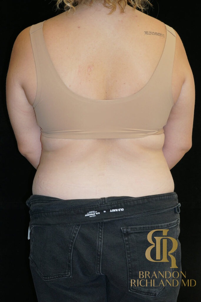 Renuvion Skin Tightening Before, Patient 36, view 6 — Dr. Brandon Richland, Newport Beach