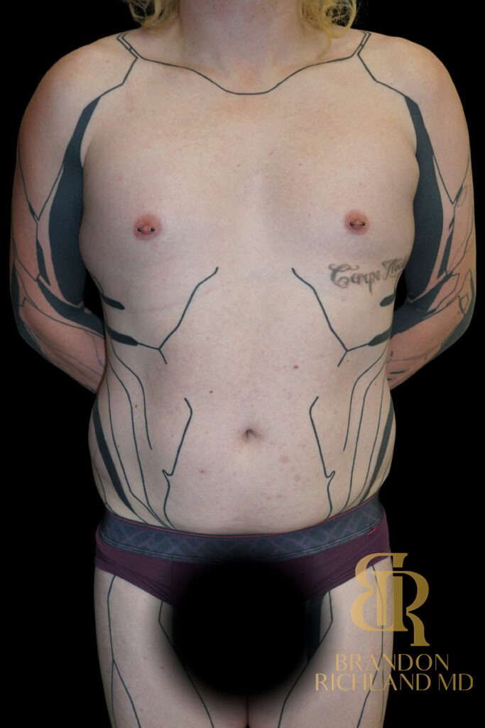 Renuvion Skin Tightening Before, Patient 38, view 1 — Dr. Brandon Richland, Newport Beach
