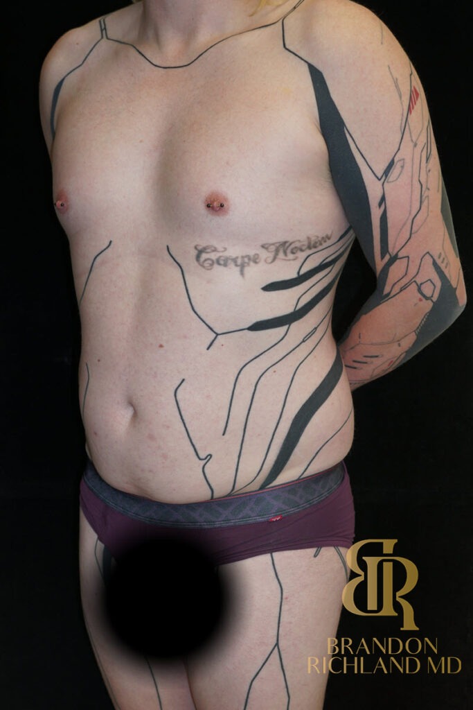 Renuvion Skin Tightening Before, Patient 38, view 4 — Dr. Brandon Richland, Newport Beach