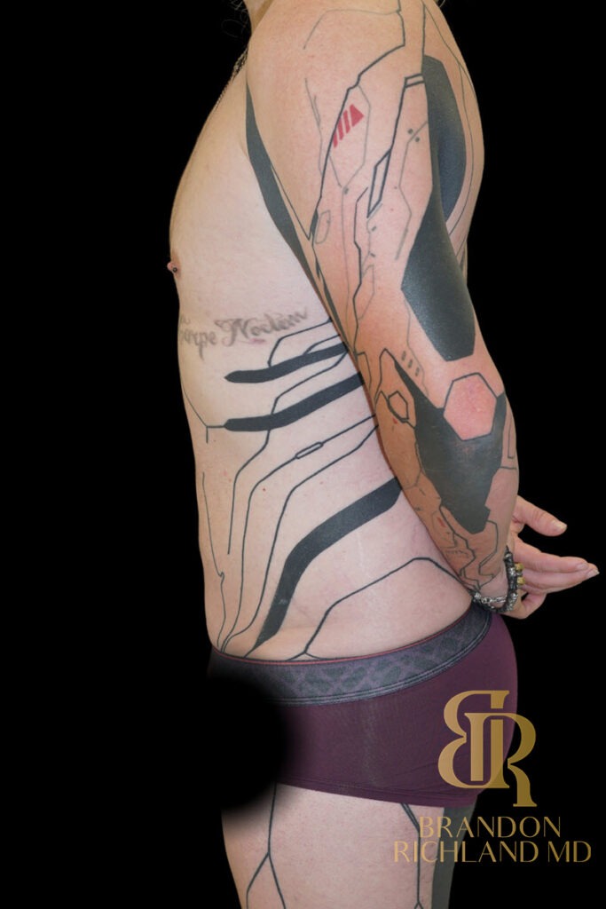 Renuvion Skin Tightening After, Patient 38, view 5 — Dr. Brandon Richland, Newport Beach