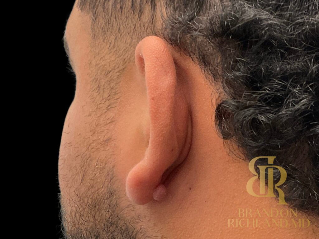 Scar Revision Before, Patient 01, view 1 — Dr. Brandon Richland, Newport Beach