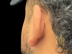 Scar Revision before and after, Patient 01 — Dr. Brandon Richland, Newport Beach
