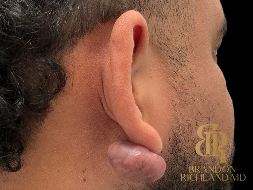 Scar Revision Before, Patient 01, view 2 — Dr. Brandon Richland, Newport Beach