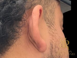Scar Revision before and after, Patient 01 — Dr. Brandon Richland, Newport Beach