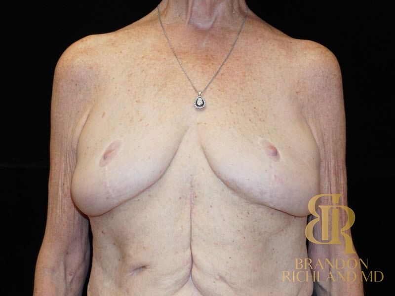 Breast Augmentation & Lift Before photo, Patient 01